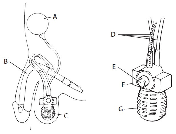 penile-prosthesis-procedure-austin-urology-institute